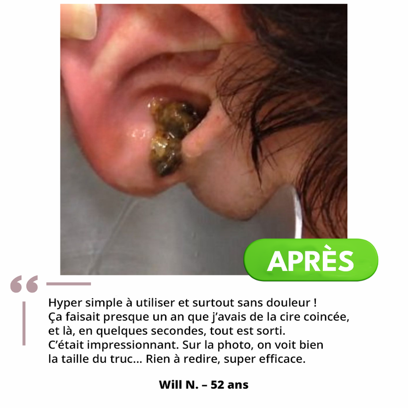 Système de Nettoyage Auriculaire™