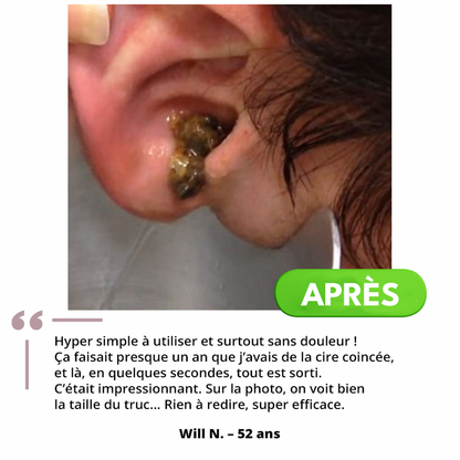 Système de Nettoyage Auriculaire™